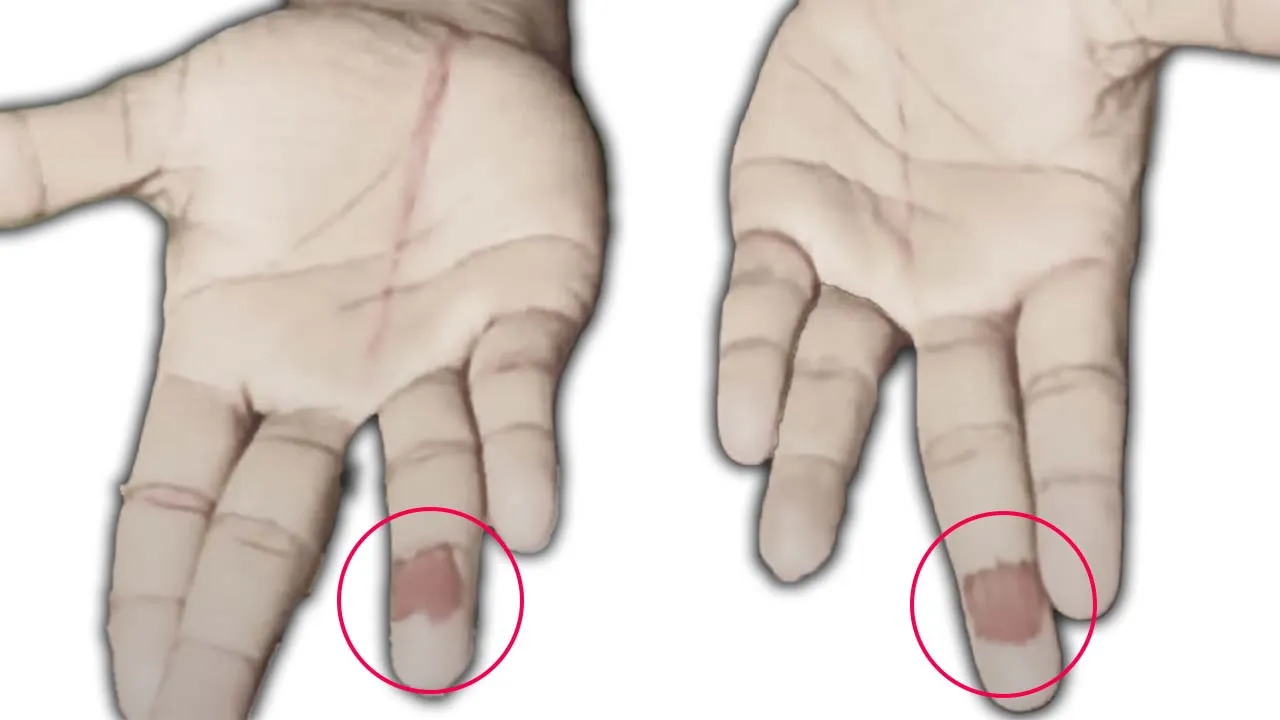 טיפול עצמי בעקב סוגוק