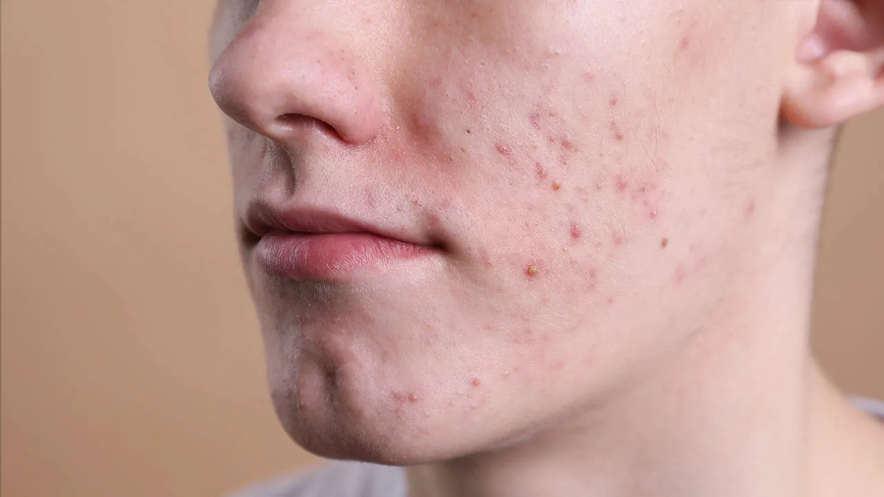 הפתרון היעיל ביותר לאקנה - רואקוטן